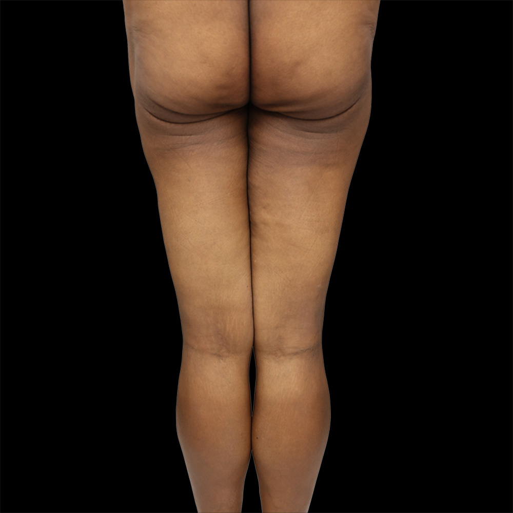 Case--4744 | Before Thigh Lift 2