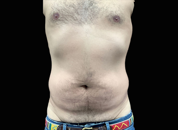 Case--6824 | Before Liposuction