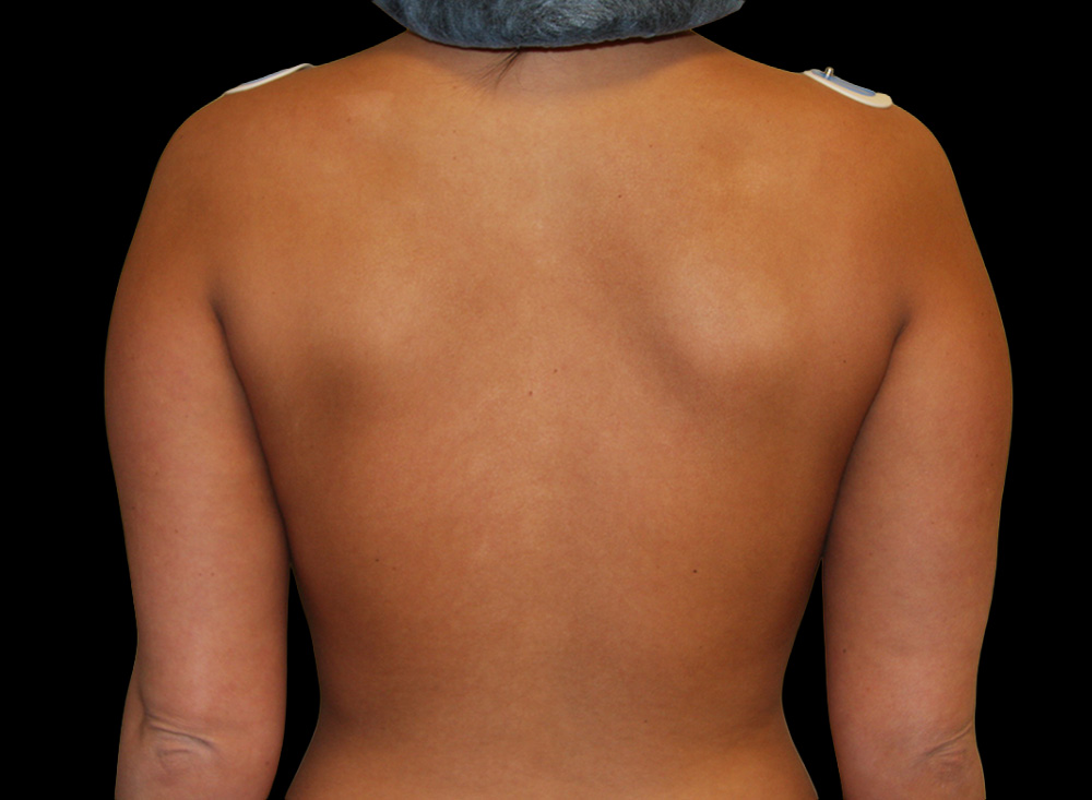 Case--2986 | Before Body Liposuction