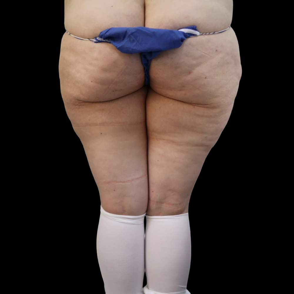 Case--7952 | Before Thigh Lift 2