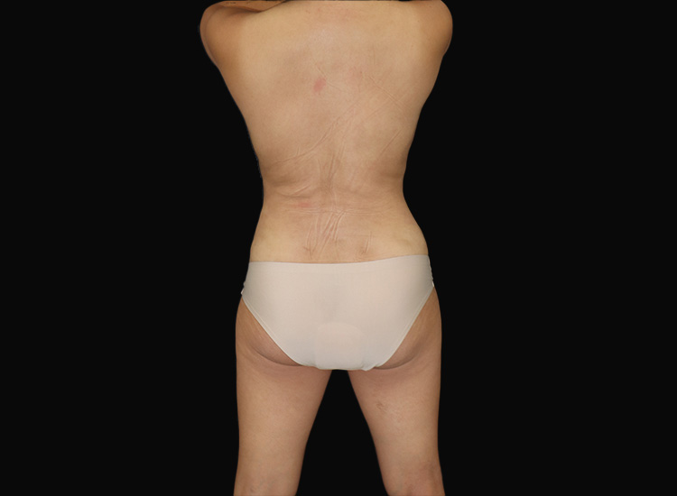 Case--8022 | After Liposuction 1