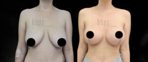Breast Lift Patient 13 Before & After - Thumbnail