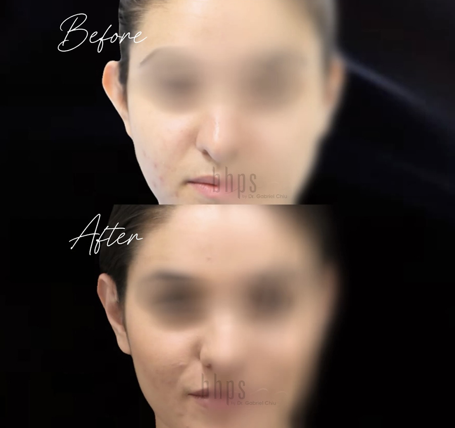 Otoplasty Patient 08 Before & After