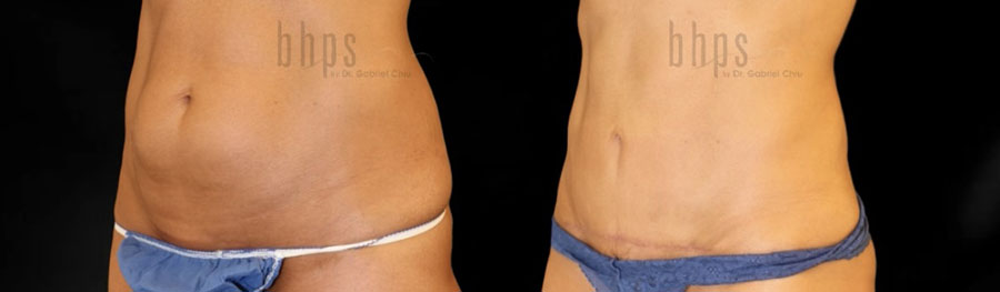 Tummy Tuck Patient 36 Before & After