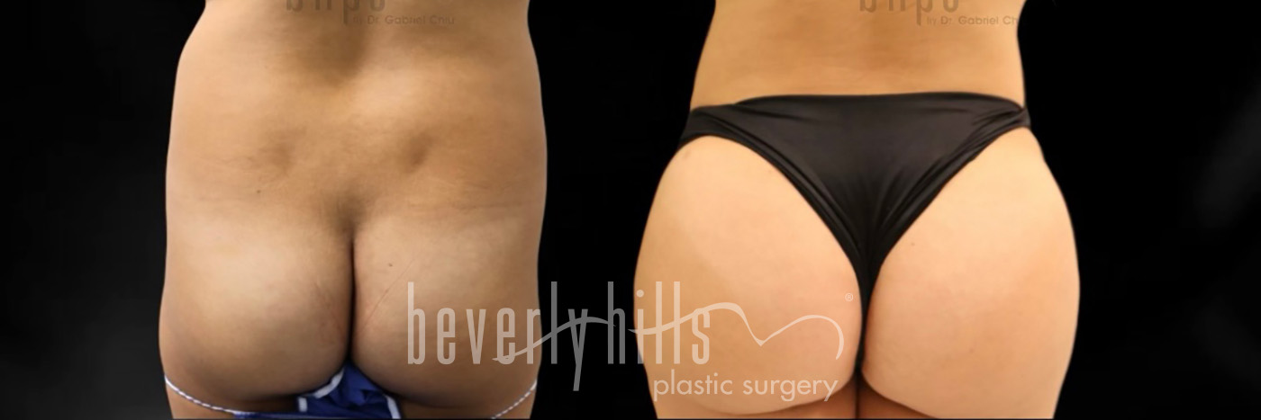 Brazilian Butt Lift Patient 36 Before & After