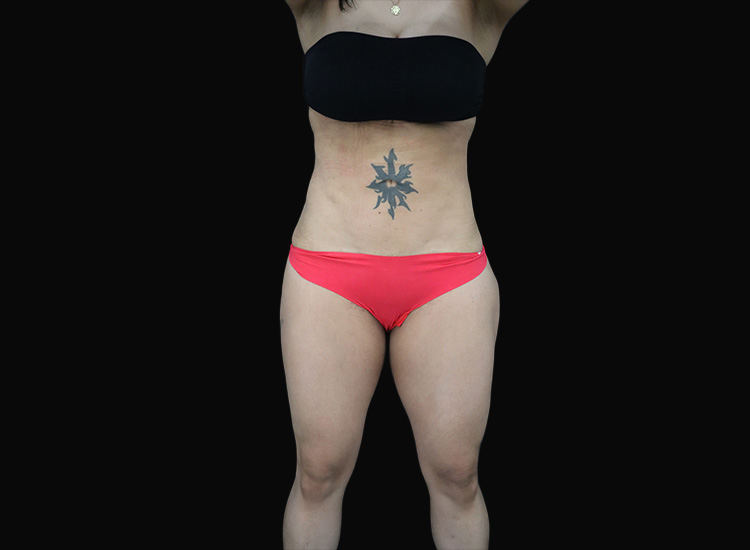 Case--4402 | After Liposuction 2