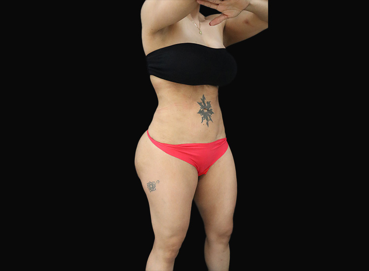 Case--4402 | After Liposuction 3