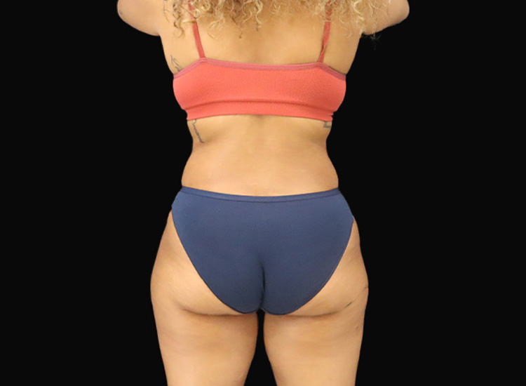 Case--5989 | After Liposuction