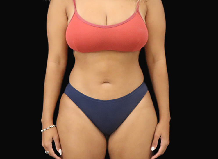 Case--5989 | After Liposuction 2