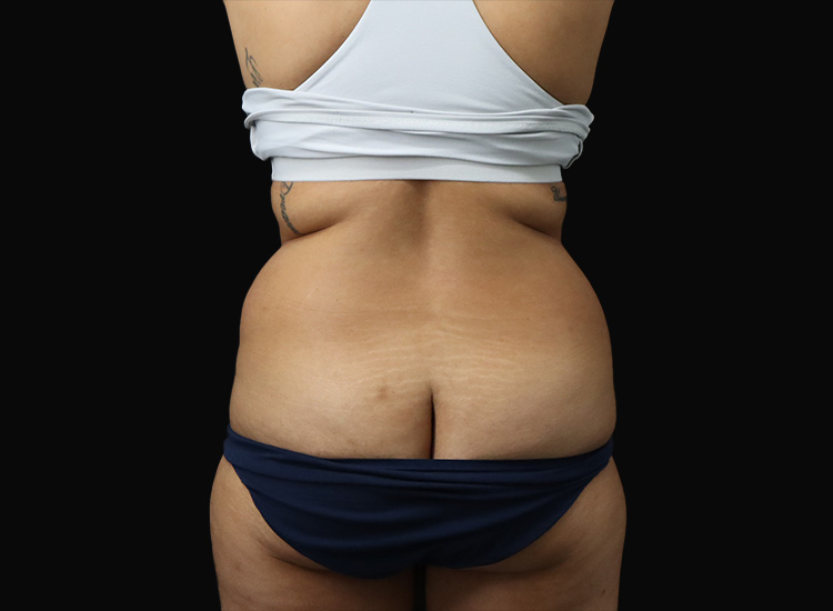 Case--5989 | Before Liposuction