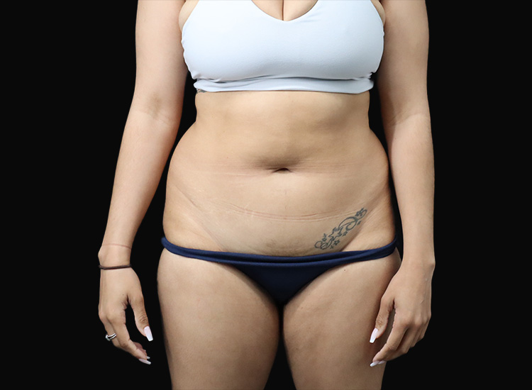 Case--5989 | Before Liposuction 2