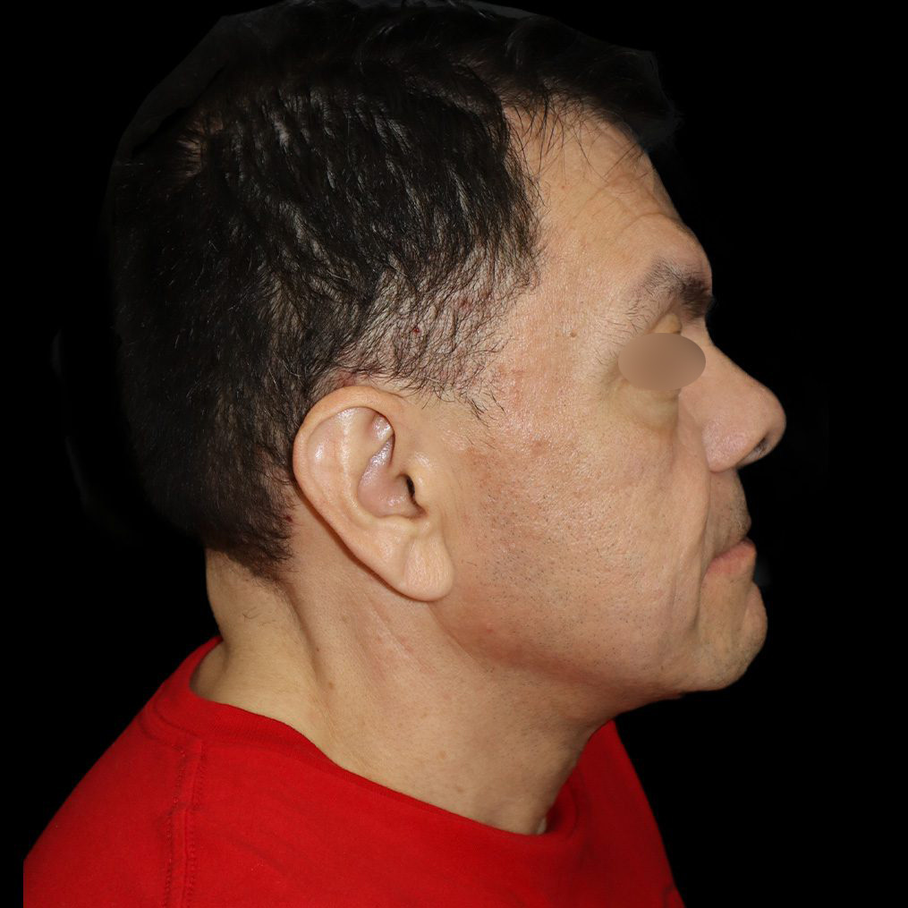 Case--4517 | After Neck Lift 1