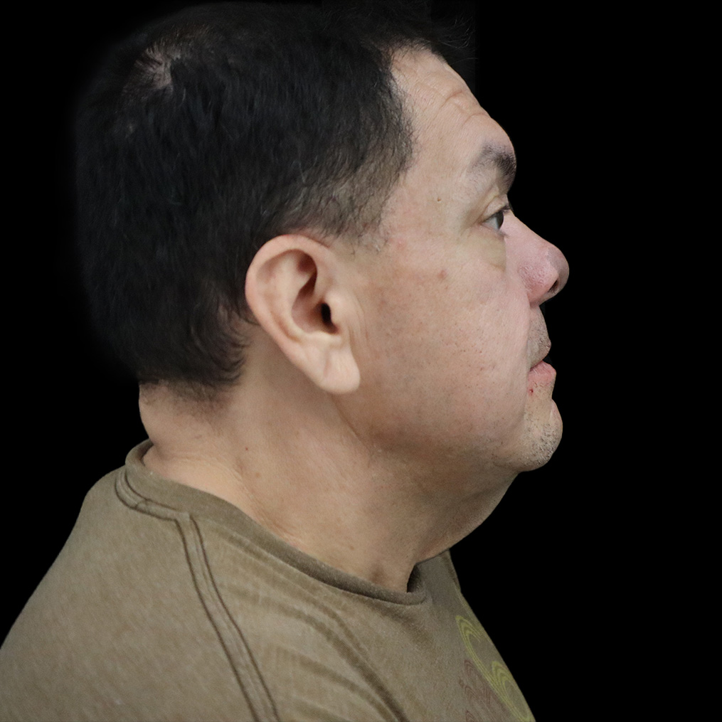 Case--4517 | Before Neck Lift