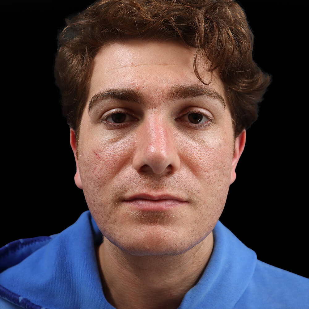 Case--7295 | After Rhinoplasty 2