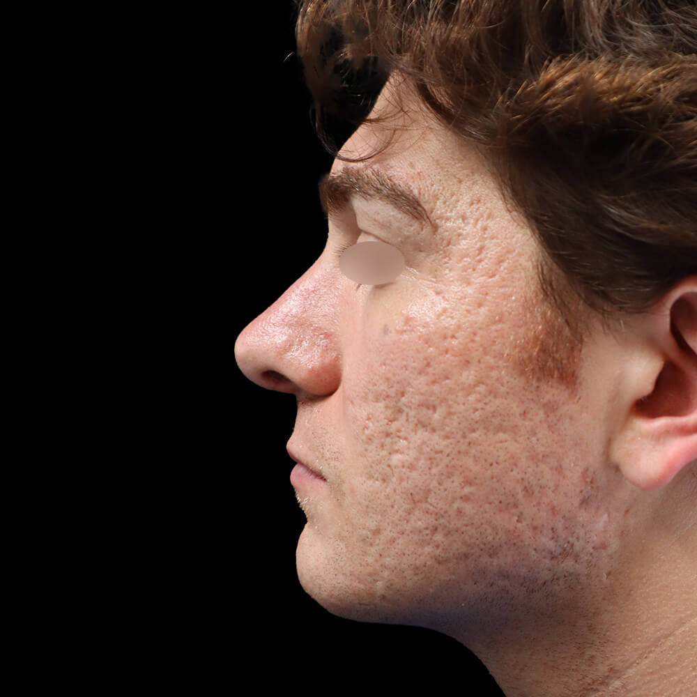 Rhinoplasty Patient After - 1
