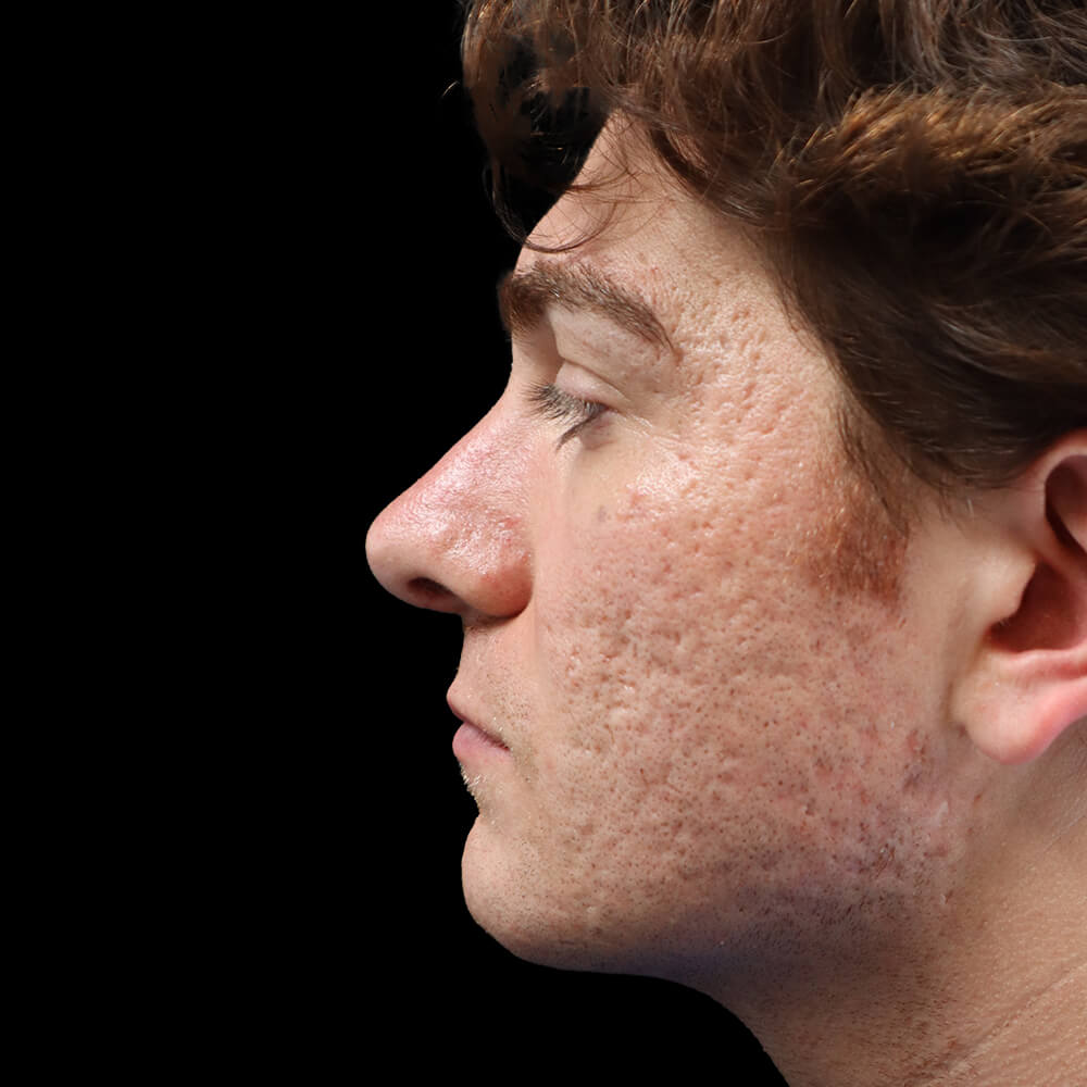 Case--7295 | After Rhinoplasty