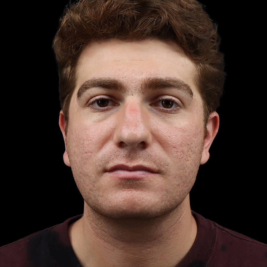 Case--7295 | Before Rhinoplasty 2