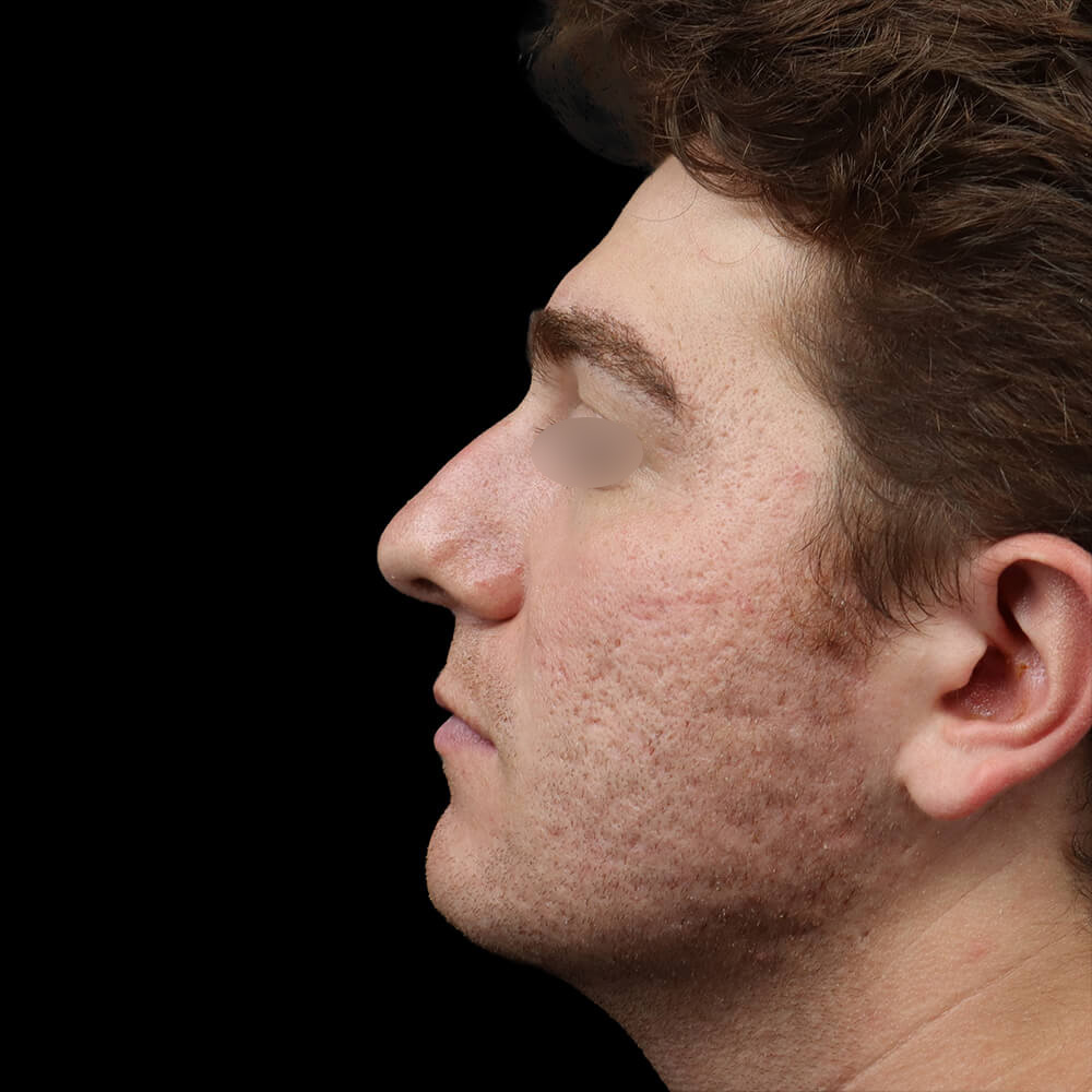 Rhinoplasty Patient Before - 1