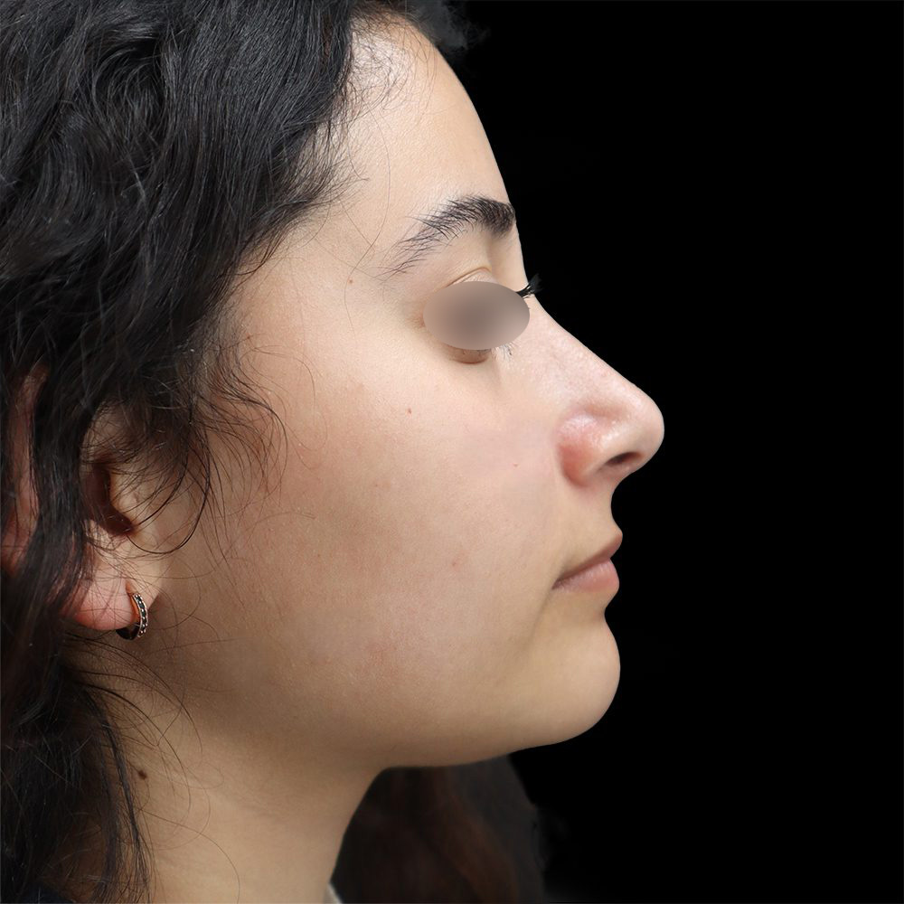 Rhinoplasty Patient After - 2