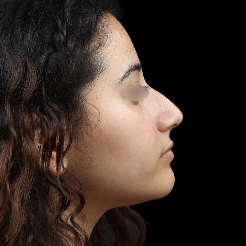Rhinoplasty Patient Before - 2