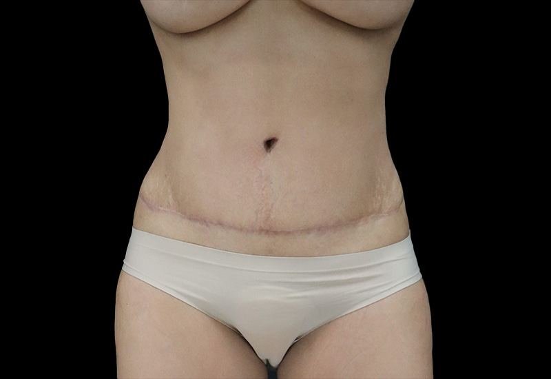 Case--8174 | After Abdominoplasty