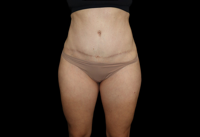 Case--4225 | After Abdominoplasty