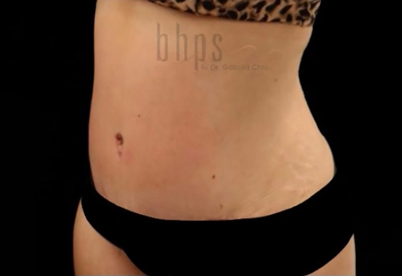 Case--3880 | After Abdominoplasty 2