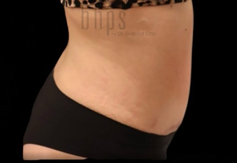 Case--3880 | After Abdominoplasty 3