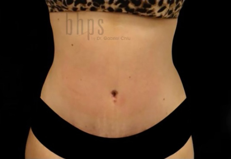 Case--3880 | After Body