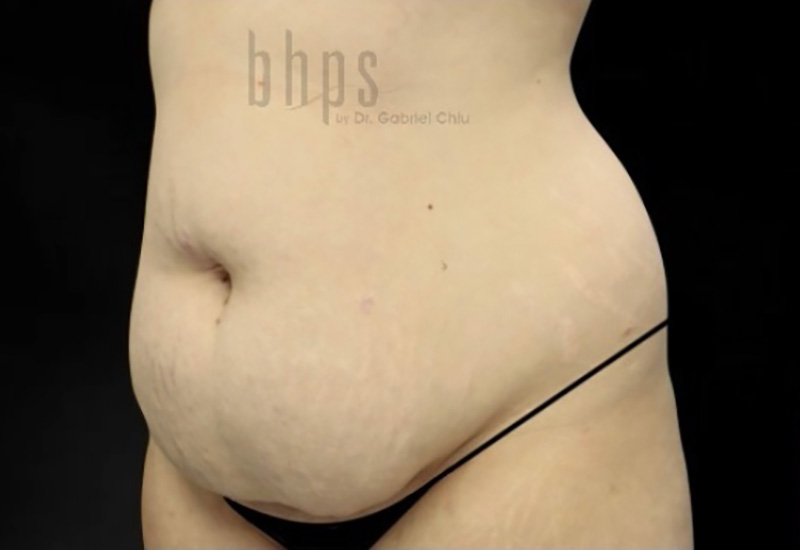 Case--3880 | Before Abdominoplasty 2