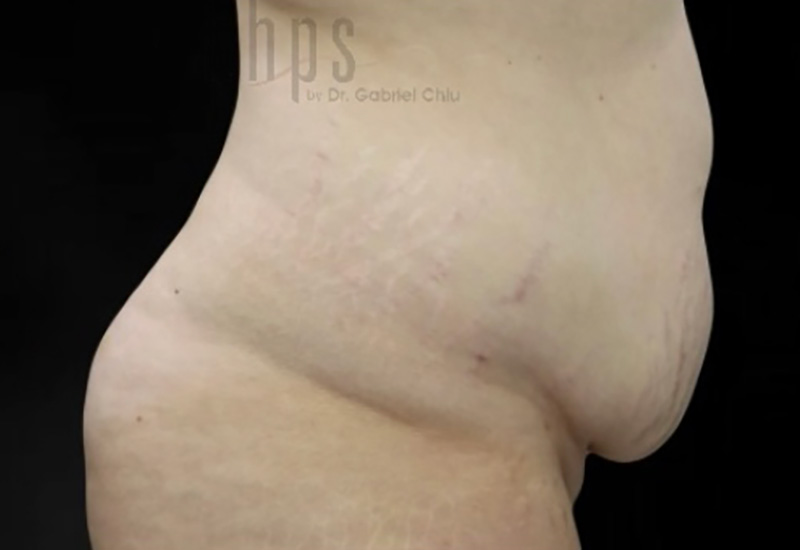 Case--3880 | Before Abdominoplasty 3