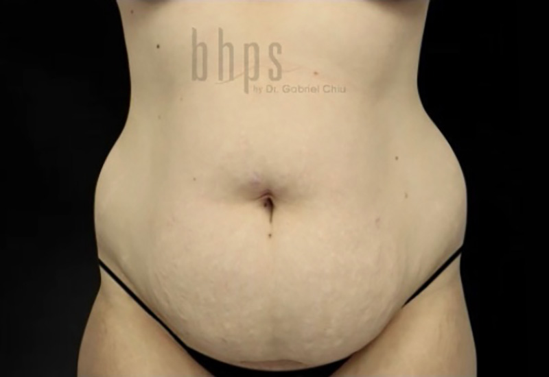 Case--3880 | Before Body