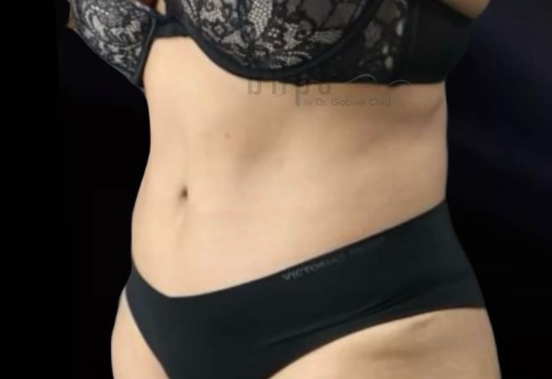 Case--4950 | After Abdominoplasty 2