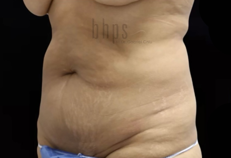 Case--4950 | Before Abdominoplasty 2