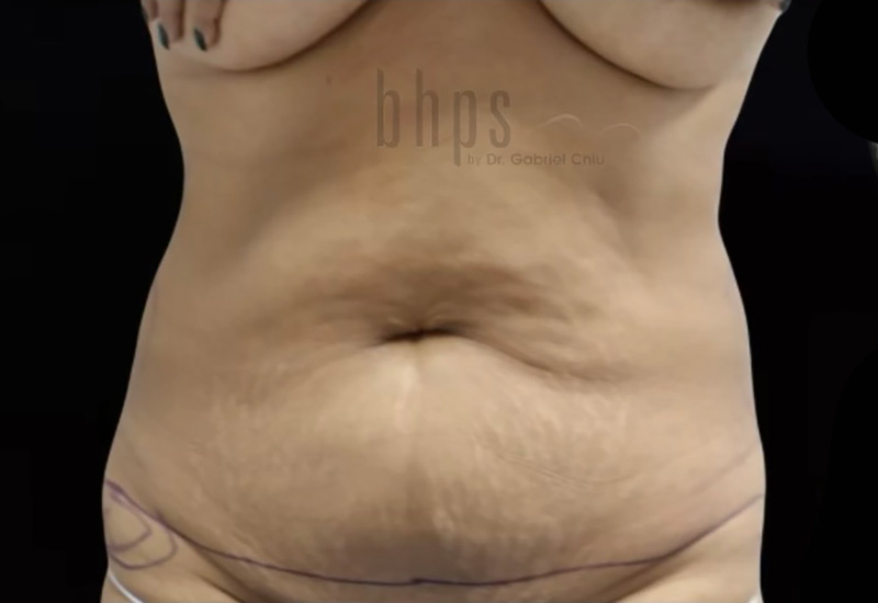 Tummy Tuck Patient Before - 1