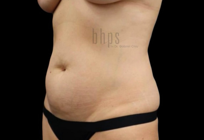 Case--7837 | Before Abdominoplasty 3