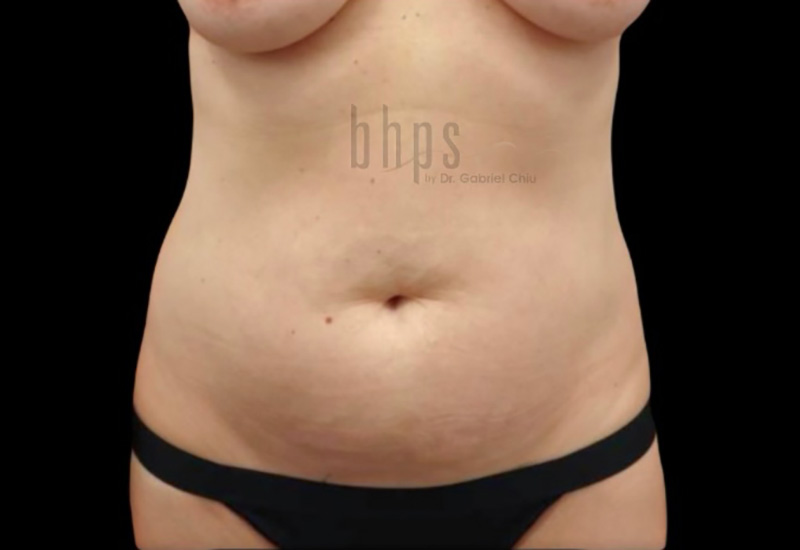Tummy Tuck Patient Before - 2