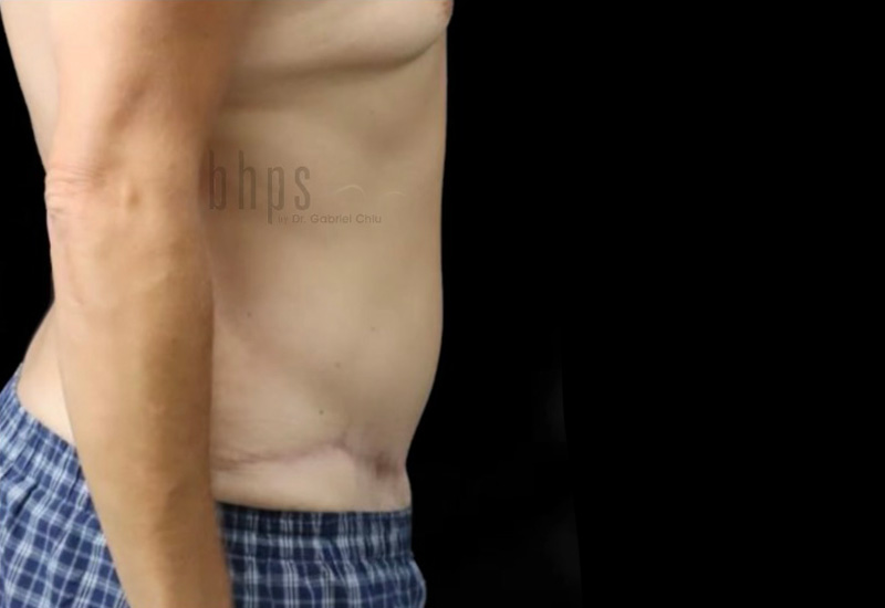 Case--9741 | After Body