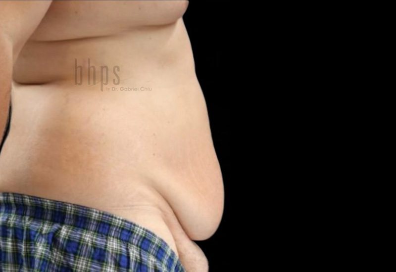 Case--9741 | Before Body