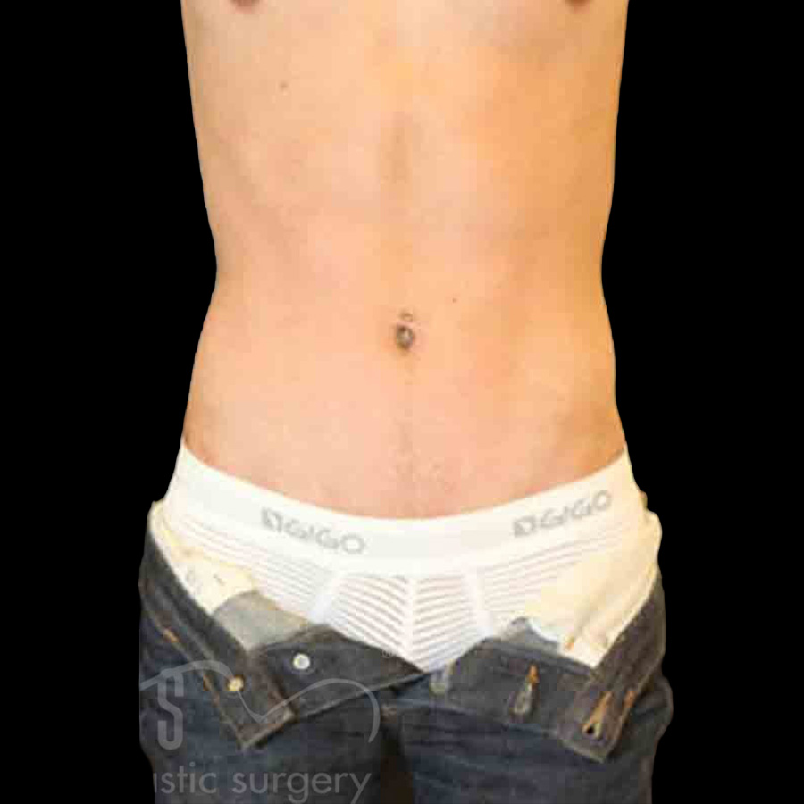 Case--3118 | After Abdominal Etching/Male Liposuction