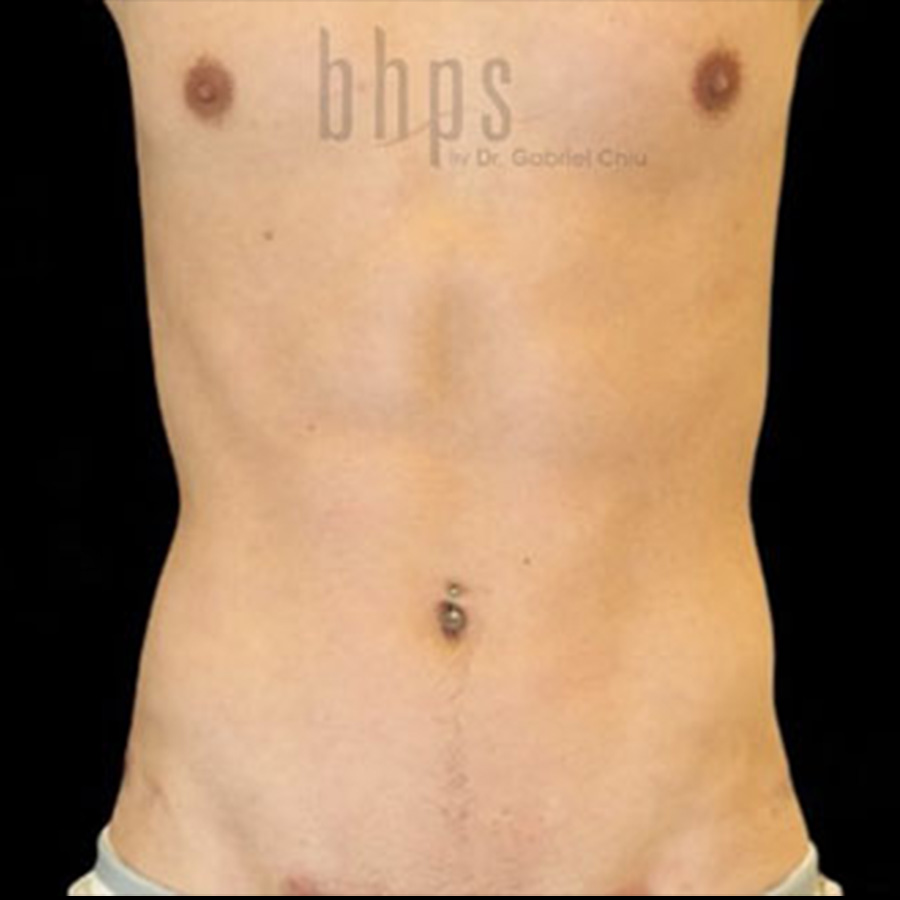 Case--5394 | After Abdominal Etching/Male Liposuction
