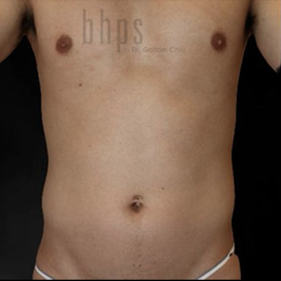 Case--5394 | Before Abdominal Etching/Male Liposuction