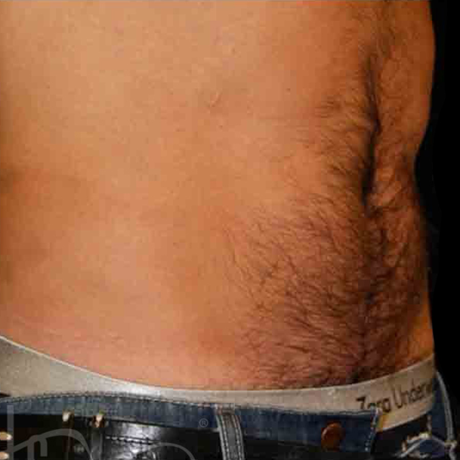 Case--4156 | After Abdominal Etching/Male Liposuction