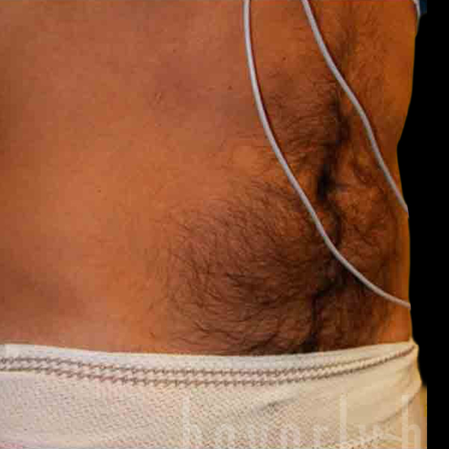 Case--4156 | Before Abdominal Etching/Male Liposuction