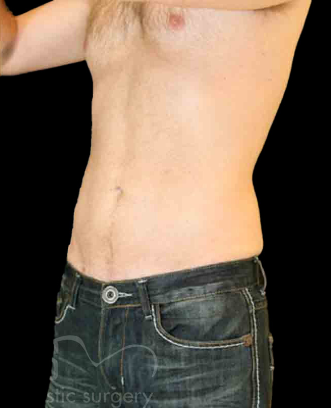 Case--8832 | After Abdominal Etching/Male Liposuction 2