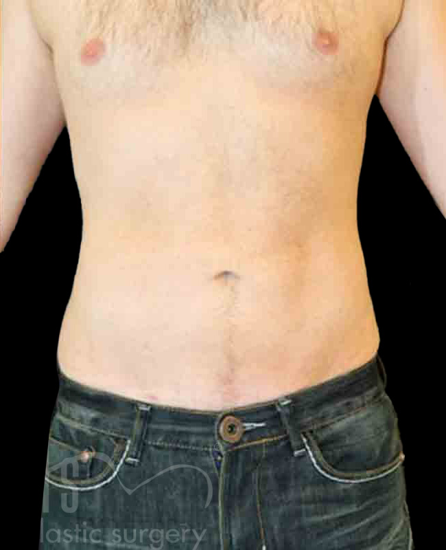 Case--8832 | After Abdominal Etching/Male Liposuction