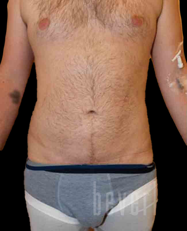 Case--8832 | Before Abdominal Etching/Male Liposuction