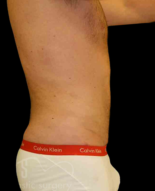 Case--4259 | After Abdominal Etching/Male Liposuction 2