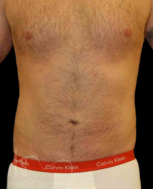 Case--4259 | After Abdominal Etching/Male Liposuction