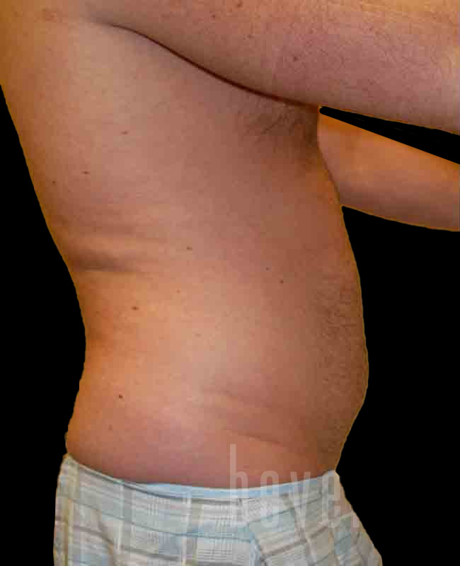 Case--4259 | Before Abdominal Etching/Male Liposuction 2